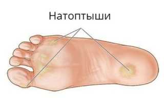 Как избавиться от натоптышей
