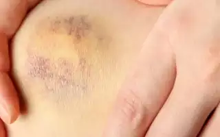Синяки после массажа: нормально ли это?