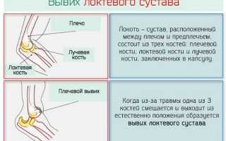 Вывих локтевого сустава у детей