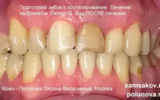 Гематома после обезболивания зуба