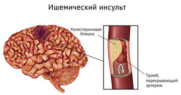 Причины микроинсульта