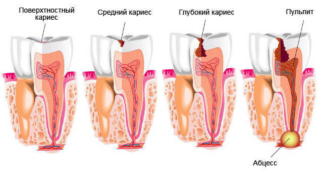 Разновидности кариеса