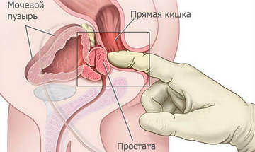Массаж простаты