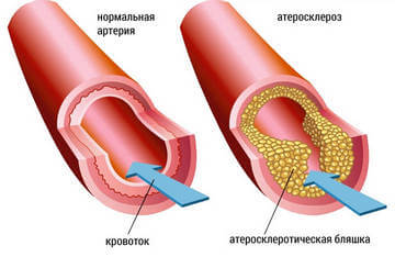 Сужение сосудов
