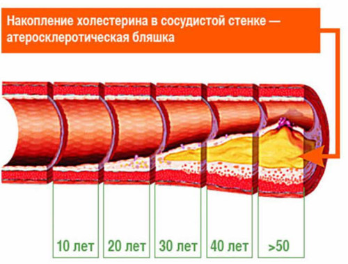 Состояние сосудов в зависимости от возраста