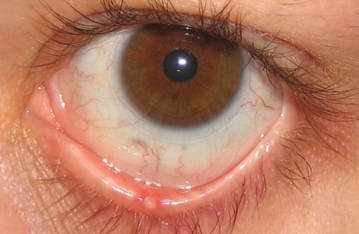 Ячмень на глазу Ячмень на глазу