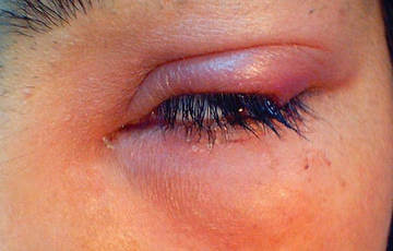 Ячмень на глазу Ячмень на глазу