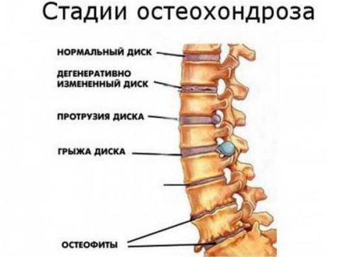 Стадии остеохондроза