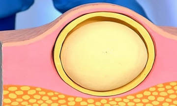 Жировик Жировик