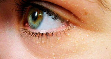 Липоматоз Липоматоз