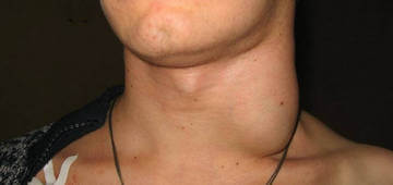 Увеличение шейных лимфоузлов Увеличение шейных лимфоузлов