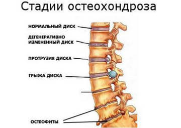 Стадии остеохондроза
