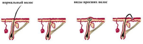 Варианты врастания волос после эпиляции