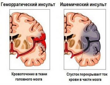 Отличие геморрагического и ишемического инсульта
