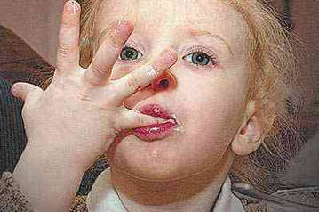 Грязные руки - причина заражения глистами Грязные руки - причина заражения глистами