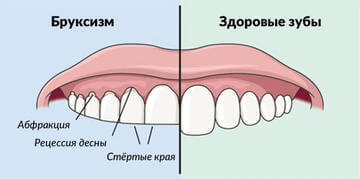 Истирание зубов при бруксизме