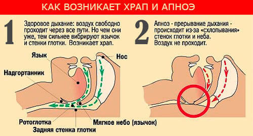 Почему человек храпитво сне