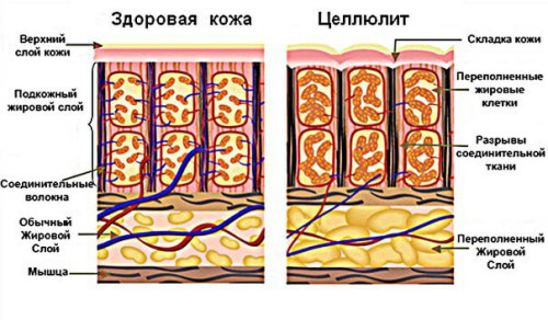Струтура кожи здоровой и подверженной целлюлиту Струтура кожи здоровой и подверженной целлюлиту