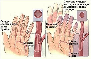 Одна из причин онемения пальцев рук - плохие сосуды