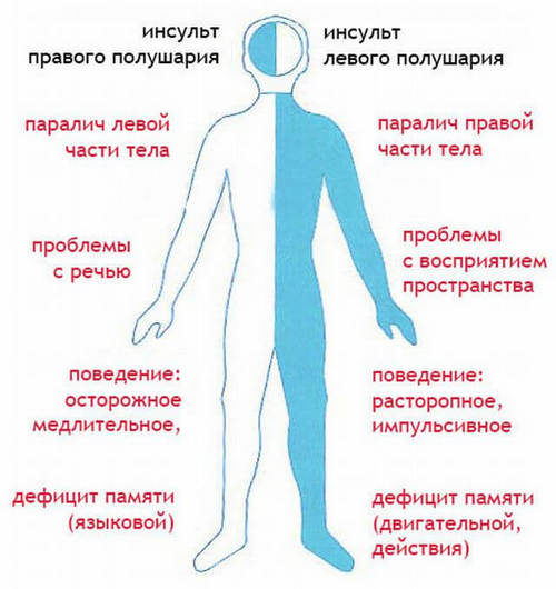 Проявления инсульта