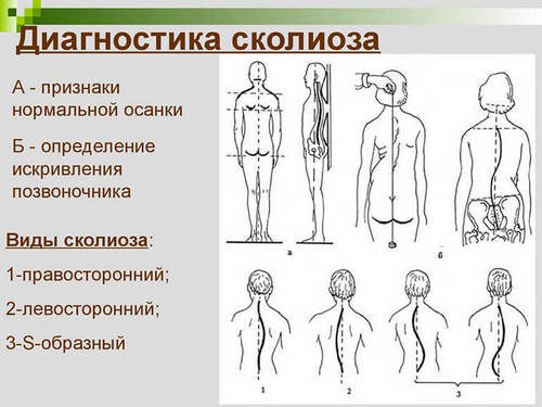 Диагностика сколиоза Диагностика сколиоза