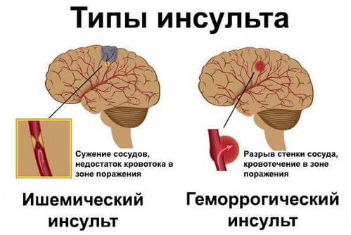 Типы инсульта