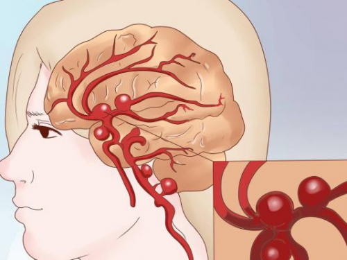Аневризмы сосудов головного мозга Аневризмы сосудов головного мозга