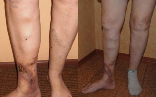 Флеботромбоз нижних конечностей Флеботромбоз нижних конечностей