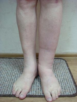 Лимфостаз нижних конечностей Лимфостаз нижних конечностей