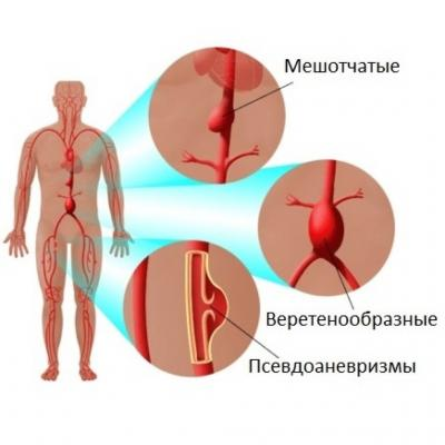 Виды аневризм Виды аневризм