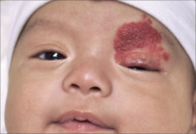 Капиллярная гемангиома Капиллярная гемангиома