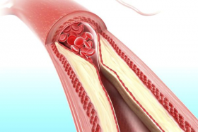 Атеросклероз артерий Атеросклероз артерий