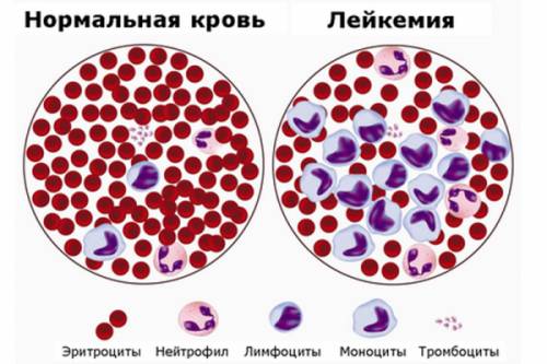 Лейкоз Лейкоз