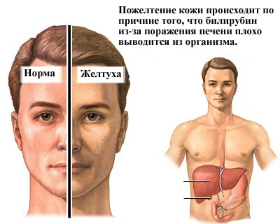 Желтуха Желтуха