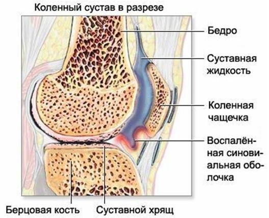 Гонартроз википедия Гонартроз википедия