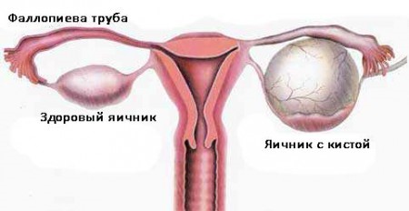 Боли в пояснице у женщин: всегда ли это заболевание почек? Боли в пояснице у женщин: всегда ли это заболевание почек?
