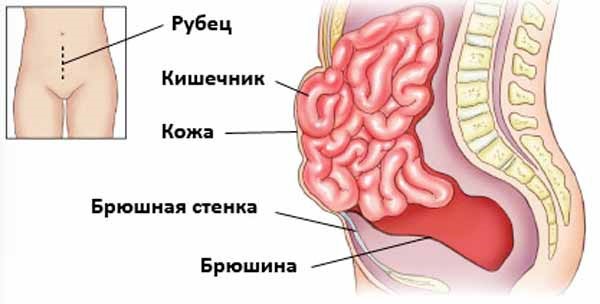 Причины, симптомы и лечение грыжи желудка Причины, симптомы и лечение грыжи желудка