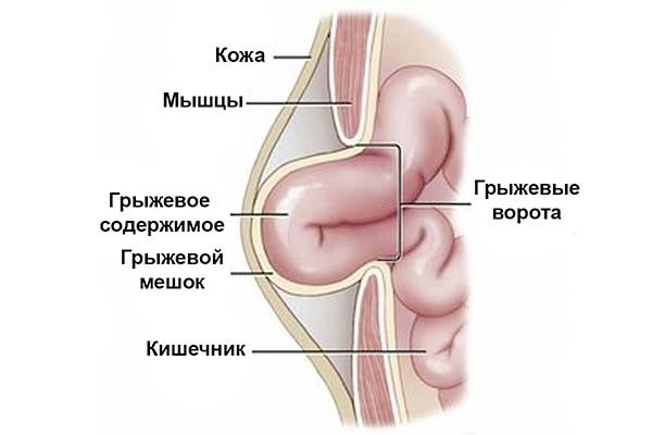 Причины, симптомы и лечение грыжи желудка Причины, симптомы и лечение грыжи желудка