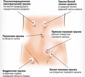 Причины, симптомы и лечение грыжи желудка Причины, симптомы и лечение грыжи желудка