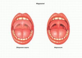 Чешется горло, зуд: причины и лечение Чешется горло, зуд: причины и лечение