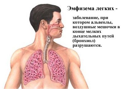 Эмфизема как осложнение астмы Эмфизема как осложнение астмы