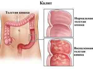 Симптомы и лечение эрозивного колита Симптомы и лечение эрозивного колита