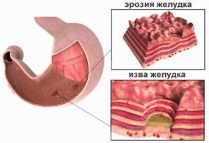 Лечение эрозий антрального отдела желудка Лечение эрозий антрального отдела желудка