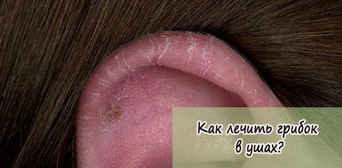 Грибок в ушах (отомикоз): симптомы и лечение Грибок в ушах (отомикоз): симптомы и лечение