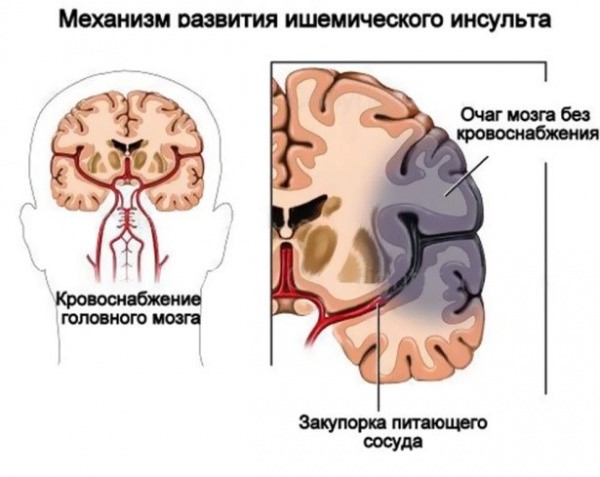 Причины инсульта головного мозга Причины инсульта головного мозга