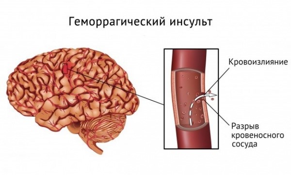 Причины инсульта головного мозга Причины инсульта головного мозга