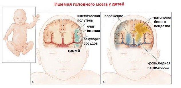 Ишемическая болезнь головного мозга: почему возникает, эффект от лечения Ишемическая болезнь головного мозга: почему возникает, эффект от лечения