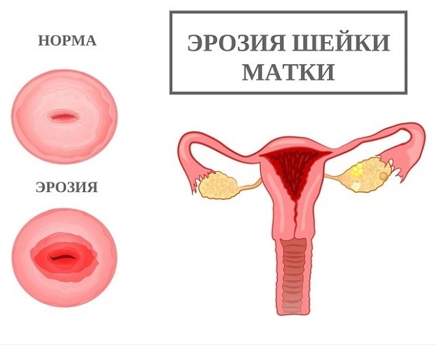 Как применять ихтиоловые свечи: инструкция Как применять ихтиоловые свечи: инструкция