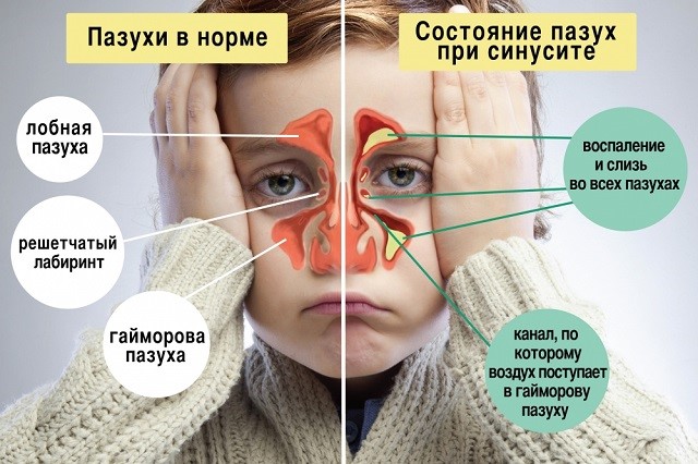 Какие можно выполнять физиопроцедуры при гайморите? Какие можно выполнять физиопроцедуры при гайморите?