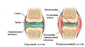 Лечение синовита коленного сустава в домашних условиях Лечение синовита коленного сустава в домашних условиях